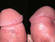 penilne papule