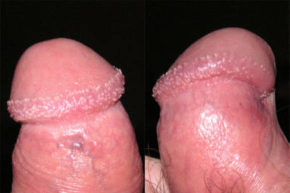penilne papule
